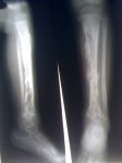 Osteomyelitis in the tibia of a child