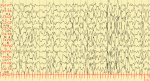 Hypsarrhythmia on EEG from Infantile Spasm