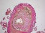 Histology of the vasculitis in temporal arteritis
