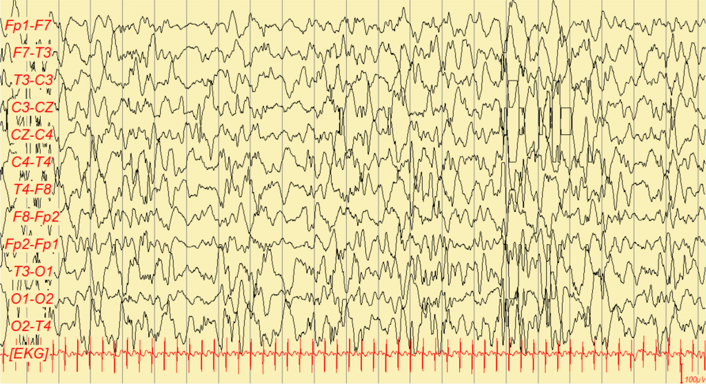 Seizures You Might See in Children – Diary of a Caribbean Med Student