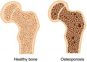 ostoeporosis