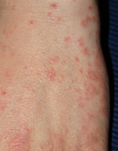 Typical scabies rash